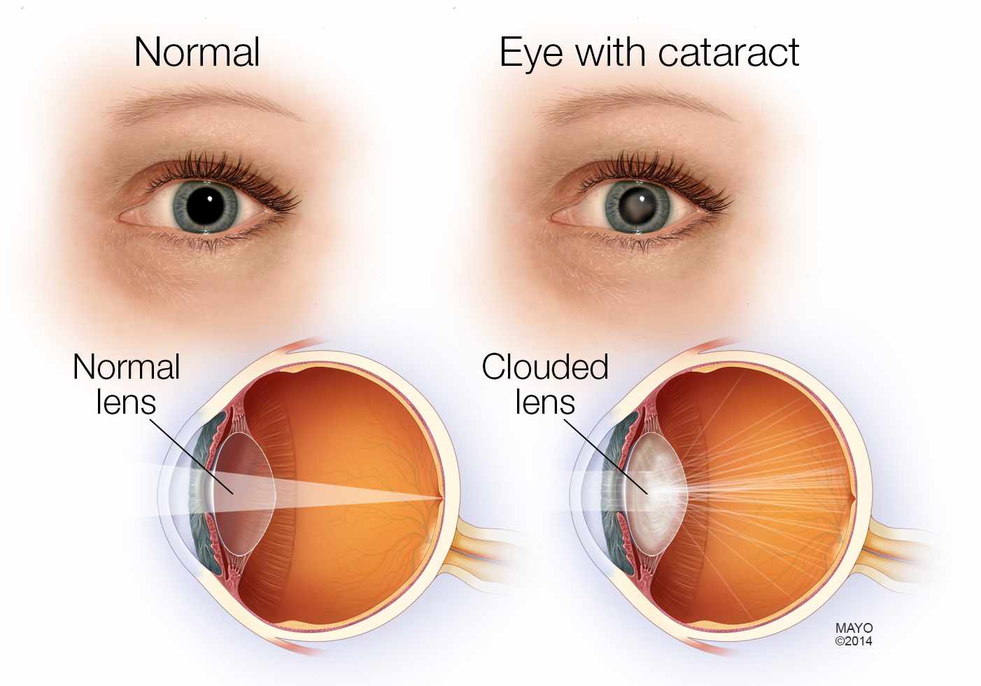Eye Cataract Operation Treatment Surgery For Aging Solution